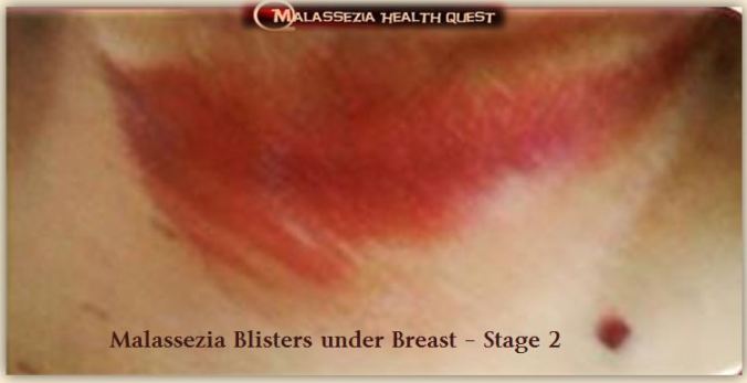 Blisters under Breast 3-MQ