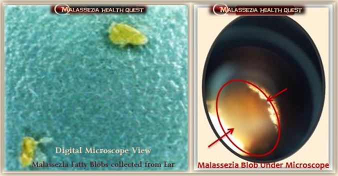Malassezia Fatty Particle under Microscope -MQ